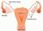 Эндометриоз: лечение, отзывы и симптомы