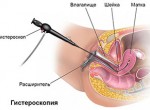 Гистероскопия матки